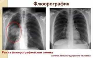 Что показывает флюорография легких курильщика