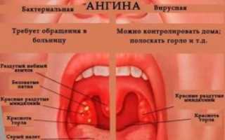 Почему не проходит ангина после антибиотиков