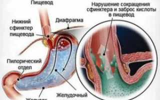 Заброс желудочного сока в горло