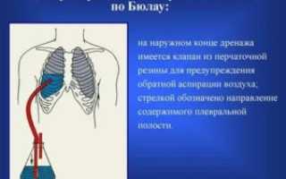 Дренирование плевральной полости при пневмотораксе