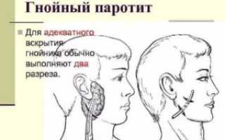 Гнойный паротит