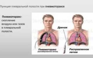 Пункция плевральной полости при пневмотораксе
