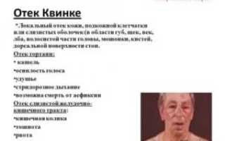 Симптомы отека квинке гортани