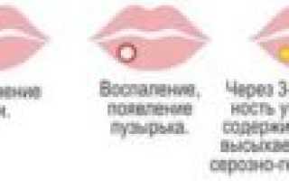 Когда герпес на губах перестает быть заразным