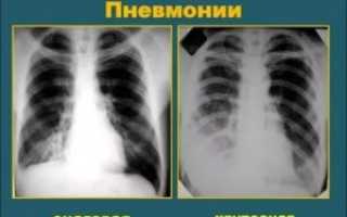 Может ли рентген не показать пневмонию