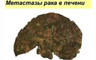 Рак легкого с метастазами в печень
