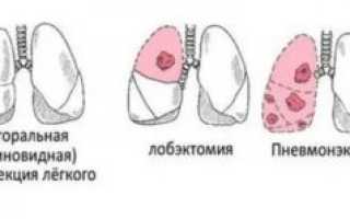 Удаление легкого при туберкулезе