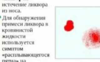 Назальная ликворея симптомы