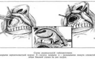 Радикальная гайморотомия последствия