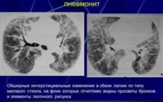 Интерстициальные изменения в легких что это