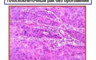 Плоскоклеточный рак с ороговением гортани