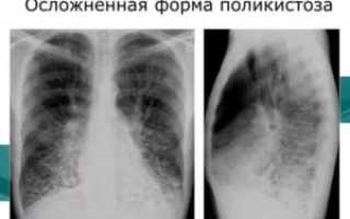 Поликистоз легких у взрослых