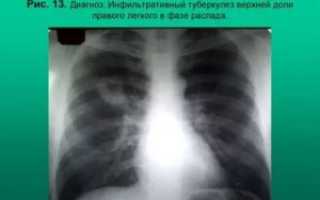 Туберкулез распад легких