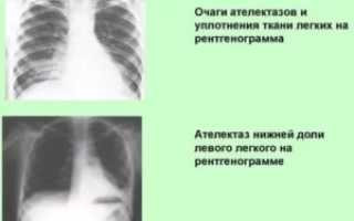 Уплотнение в лёгком что это