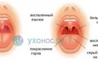 Долго не проходит горло температуры нет
